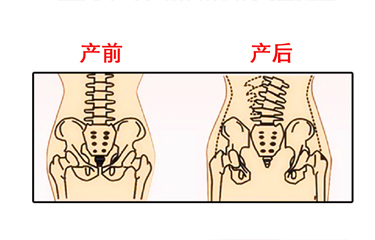 月子期間盆骨儀器修複時間有限製嗎？與手法修複相比哪個效果好？